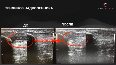 Аппарат для радиочастотной клеточной электротерапии WINTECARE T-Plus