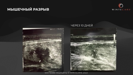 Аппарат для радиочастотной клеточной электротерапии WINTECARE T-Plus
