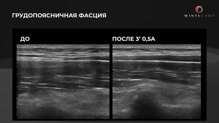 Аппарат для радиочастотной клеточной электротерапии WINTECARE T-Plus