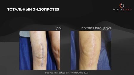 Аппарат для радиочастотной клеточной электротерапии WINTECARE T-Plus