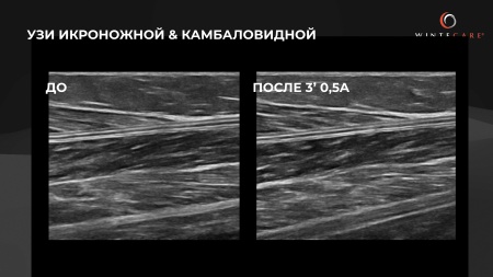Аппарат для радиочастотной клеточной электротерапии WINTECARE T-Plus