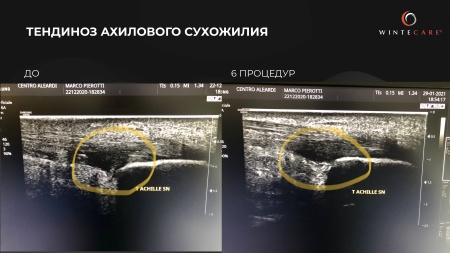 Аппарат для радиочастотной клеточной электротерапии WINTECARE T-Plus