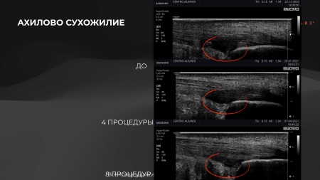 Аппарат для радиочастотной клеточной электротерапии WINTECARE T-Plus